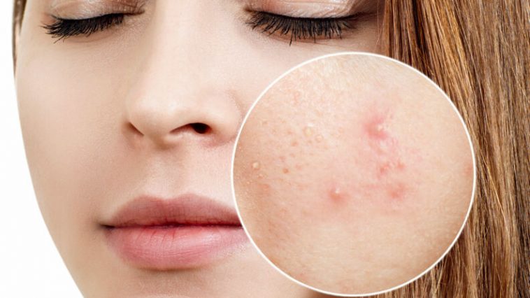 girl with acne